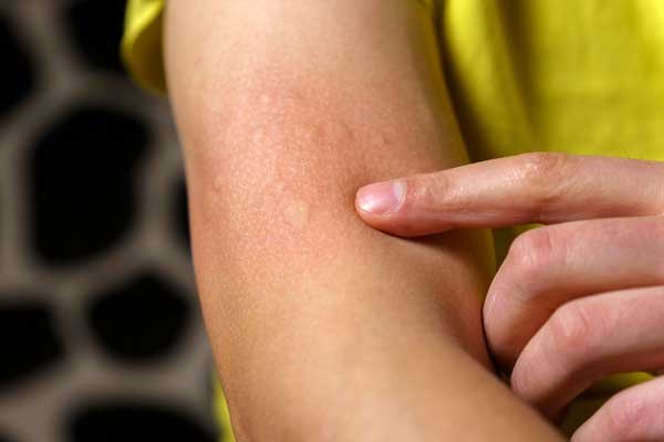 10 Tips to Get Rid of Hives