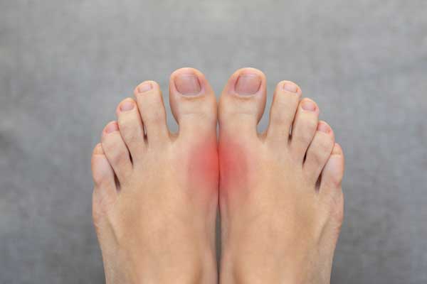 The #1 Best Protocol for Gout: Natural Remedies to Help Excrete Uric Acid